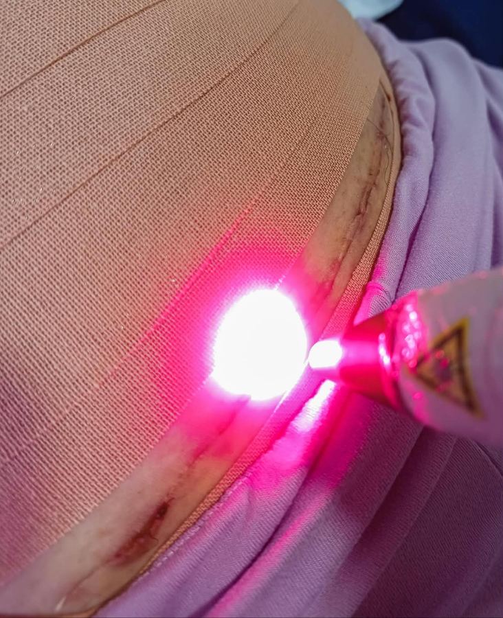 Aplicação de laserterapia sobre uma cicatriz, com a luz do laser em contato com a pele